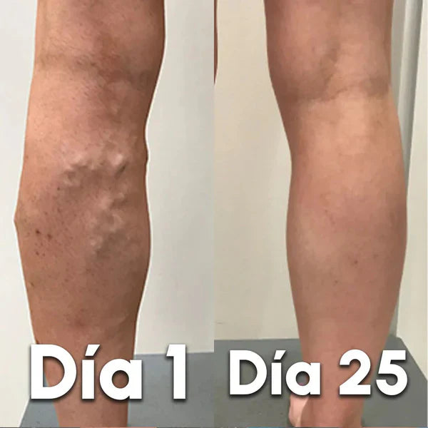 VariceFree Pro Kit Premium Spray + Parches